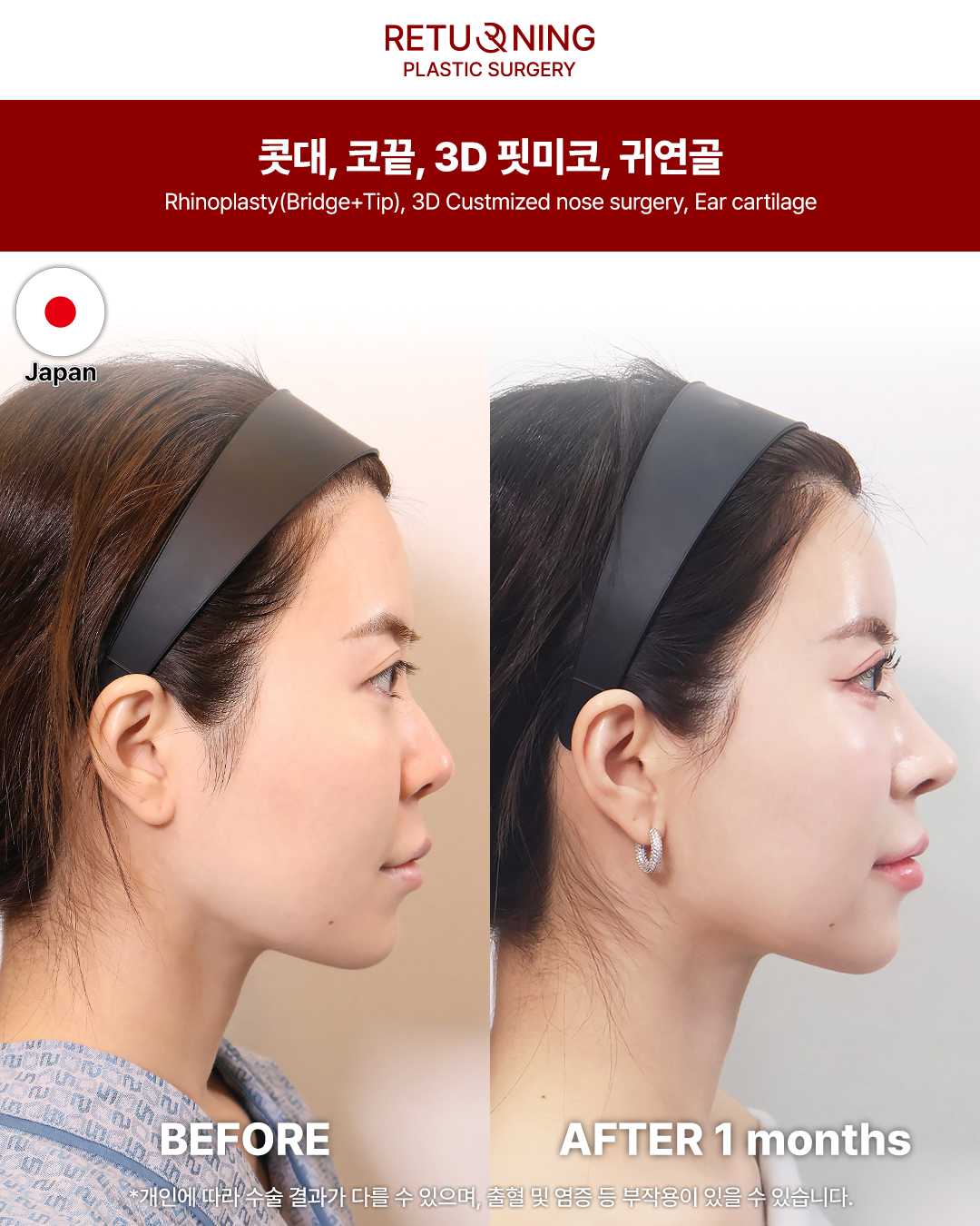 Ринопластика До и После Изображение