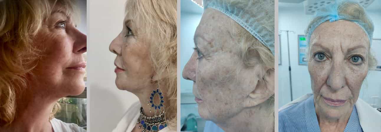 До и после подтяжки лица в Индии