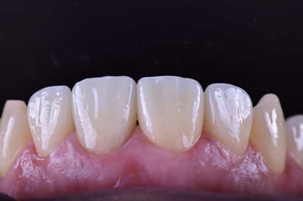 Carilla Dental en Los Algodones, México