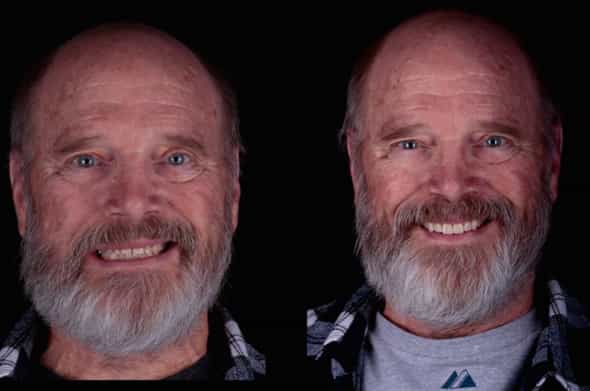 All on 4 Dental Implants in Los Algodones