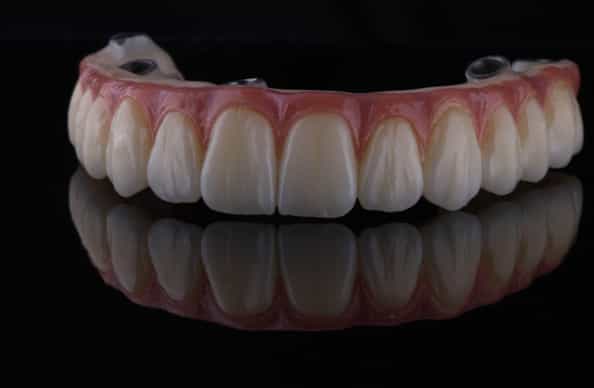 All on Four Dental Implants in Los Algodones, Mexico