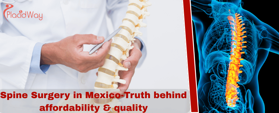 Affordable Spine Surgery in Mexico banner img
