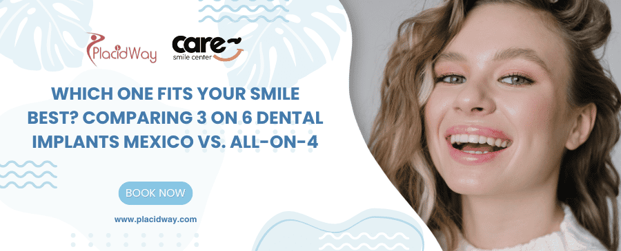Which One Fits Your Smile Best? Comparing 3 on 6 Dental Implants Mexico vs. All-on-4