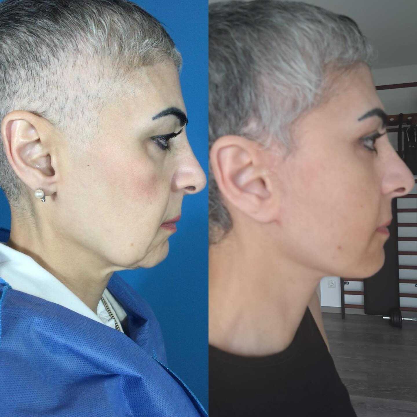 Before After Facelift in Mexico City