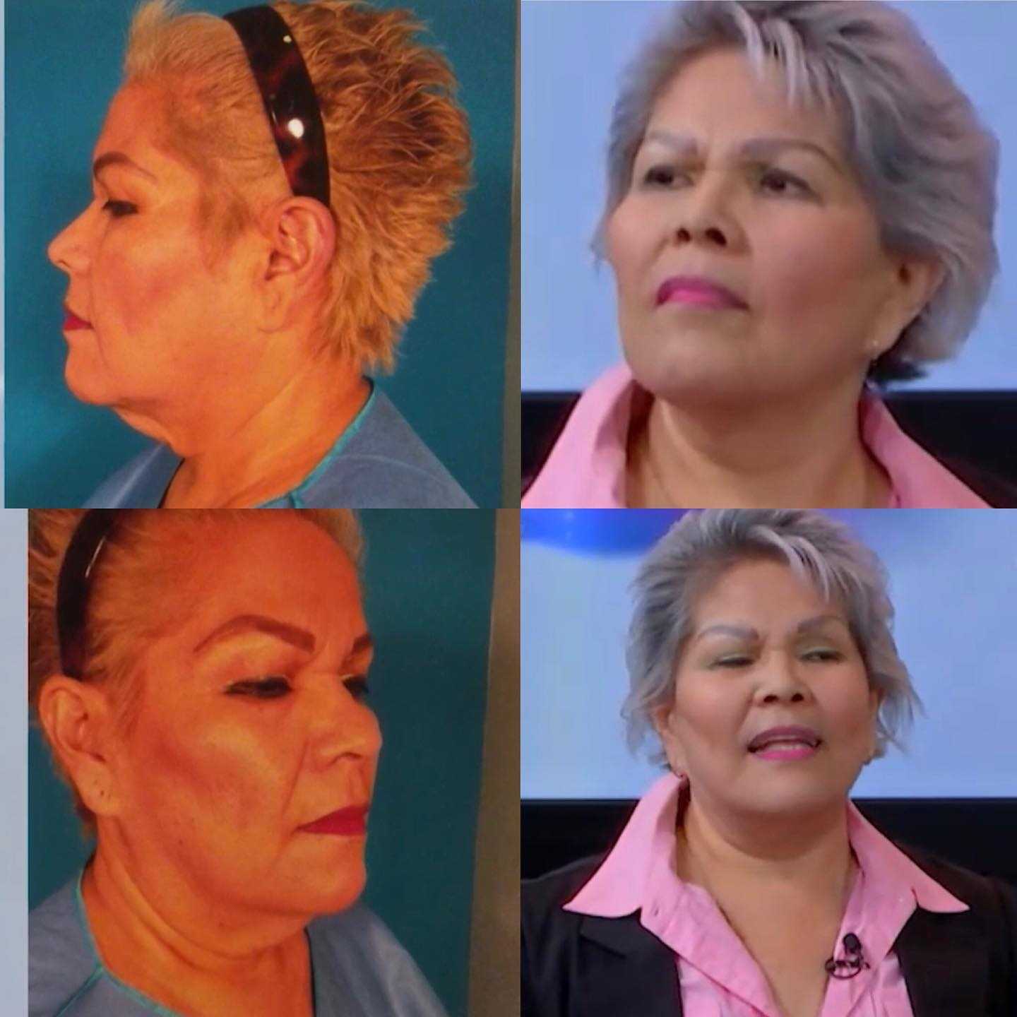 Before After Neck Lift in Mexico City
