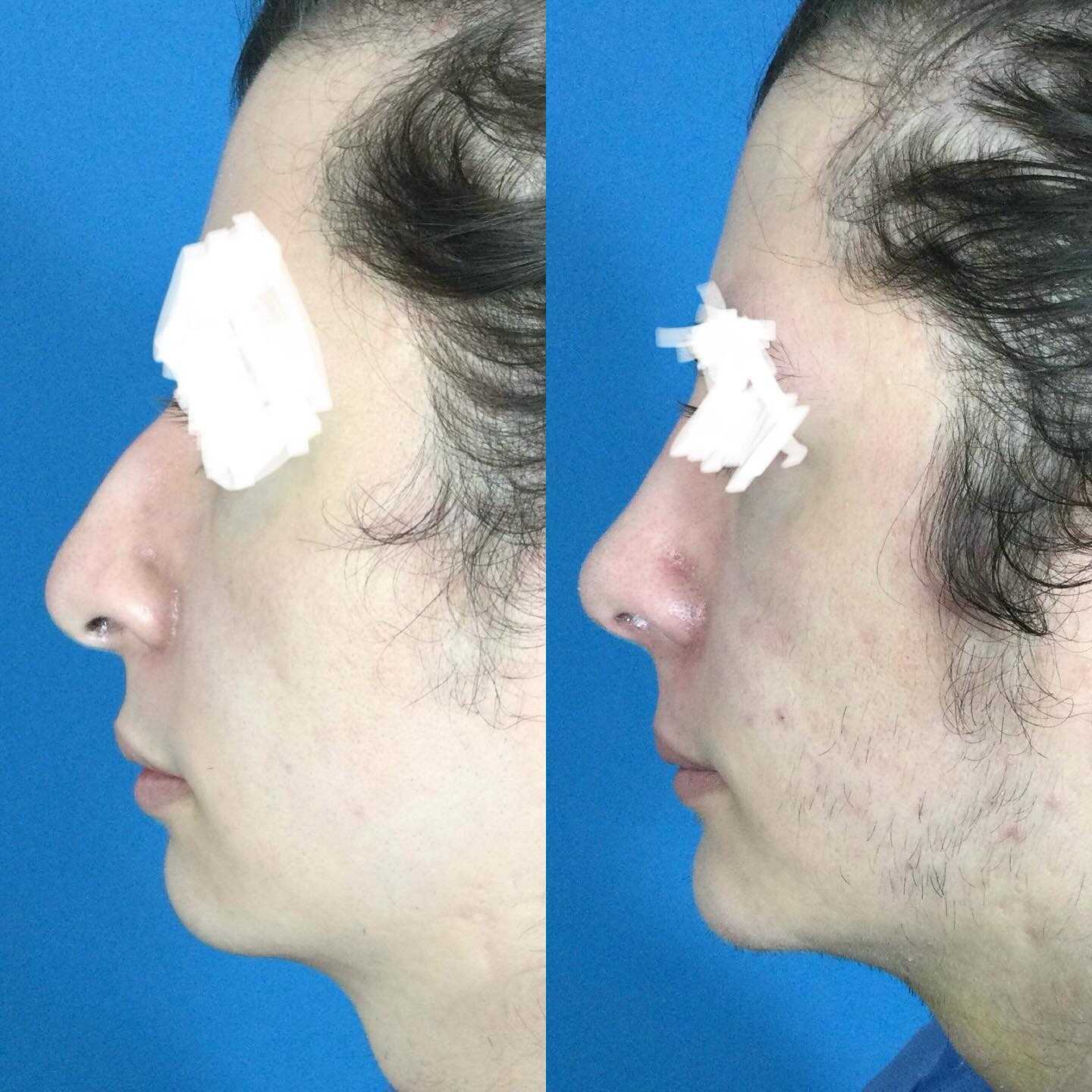 Before After Rhinoplasty in Mexico City