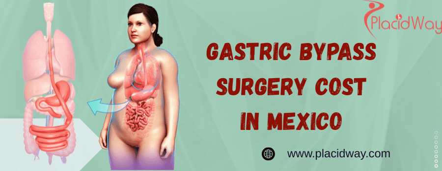 gastric bypass surgery cost in Mexico