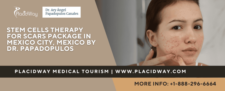 Stem Cells Therapy for Scars Cost in Mexico