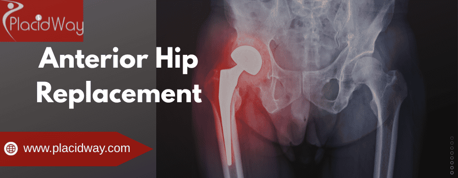 anterior hip replacement