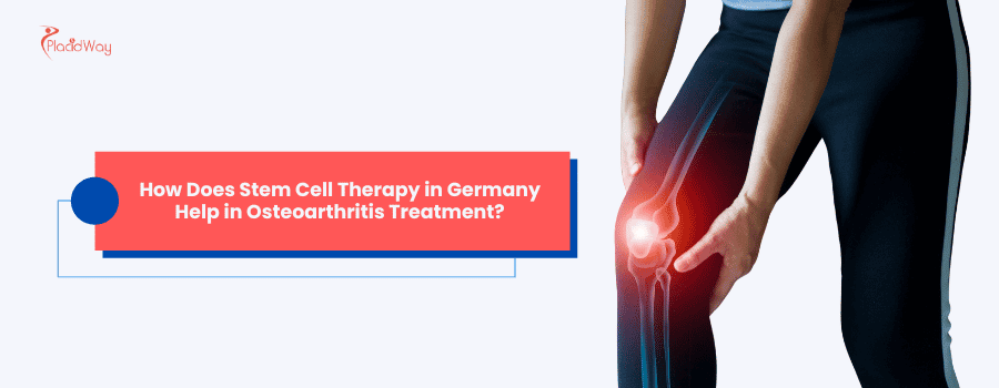 ¿Cómo ayuda la terapia con células madre en Alemania en el tratamiento de la osteoartritis?