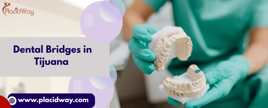  Dental Bridges in Tijuana