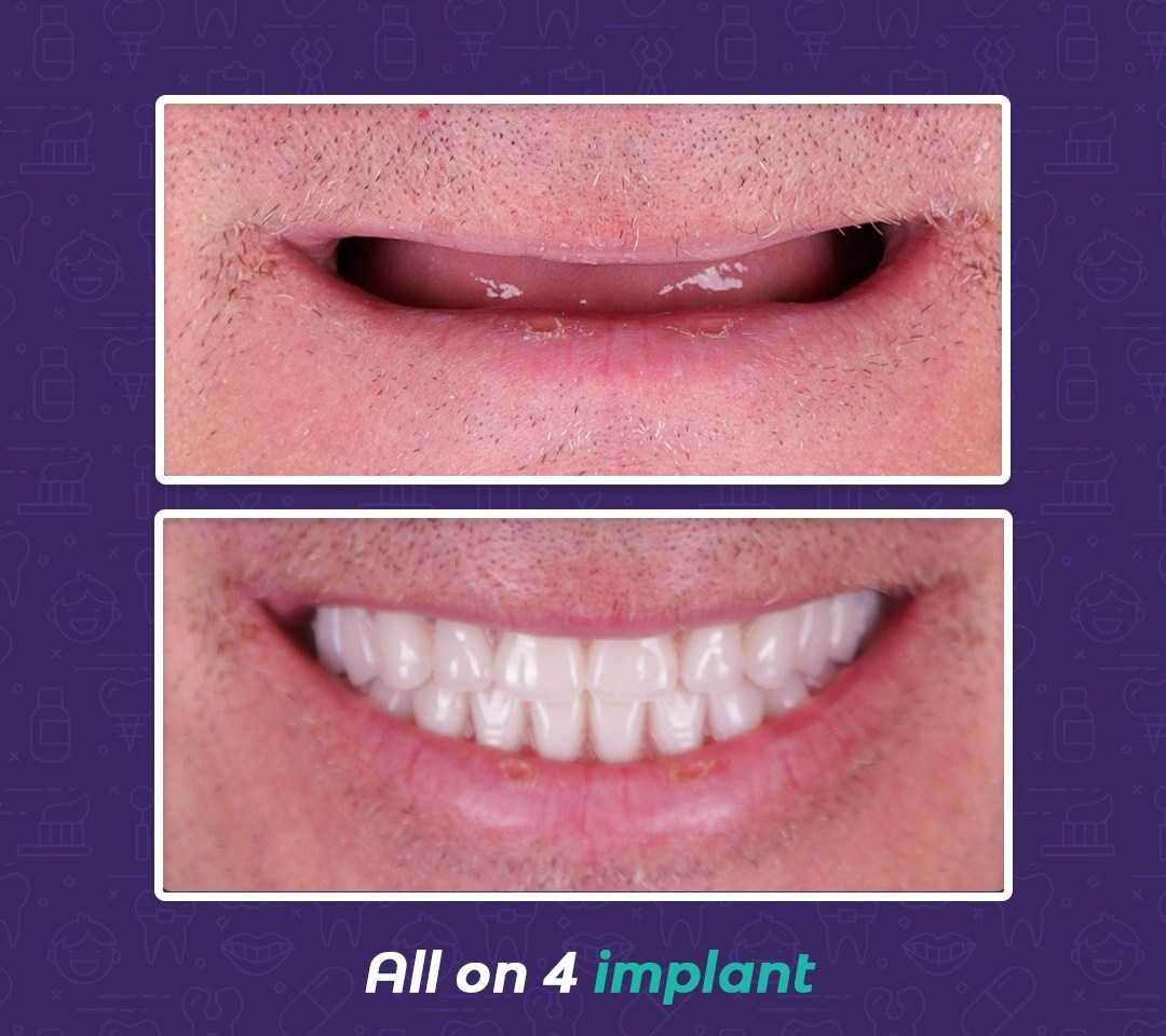 قبل وبعد زراعة الأسنان في مركز All on 4 في إسطنبول، تركيا