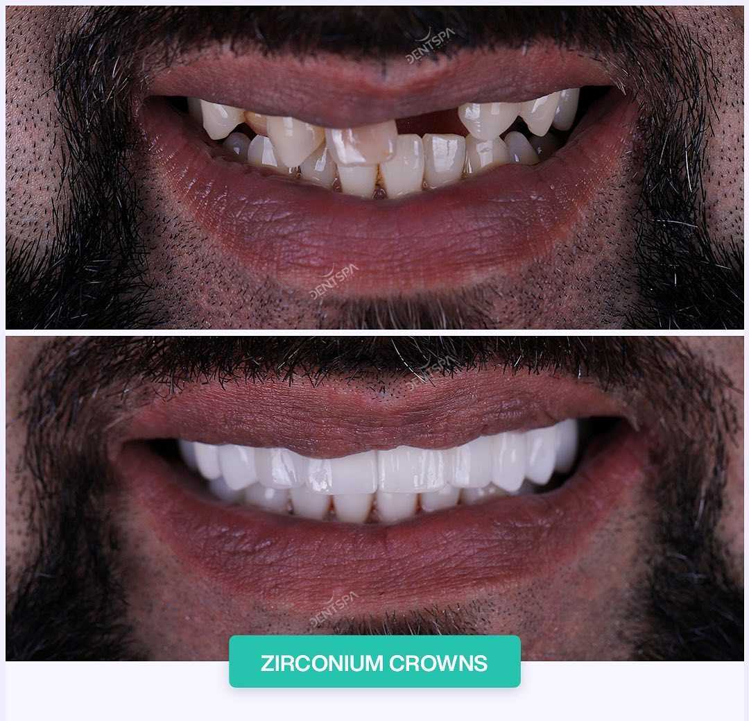 قبل وبعد تركيب تاج الأسنان في اسطنبول تركيا