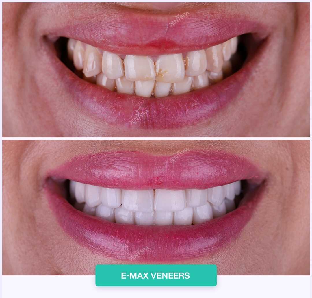 قبل وبعد تركيب قشور الأسنان في اسطنبول تركيا