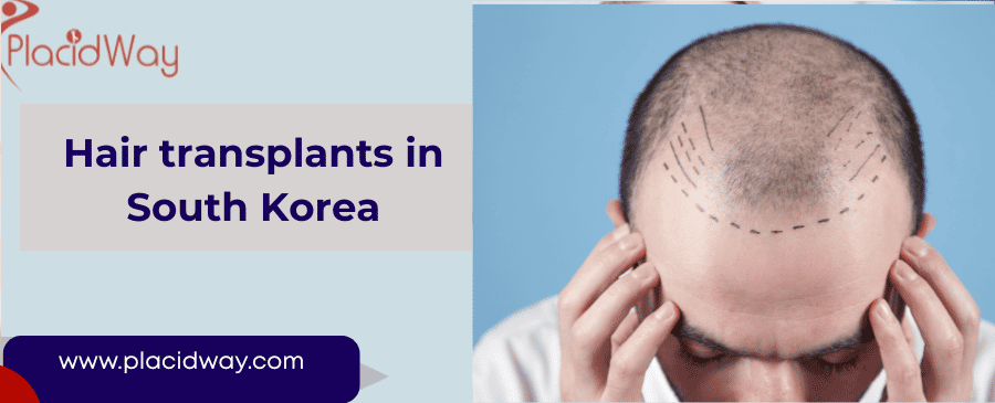 Hair transplants in South Korea