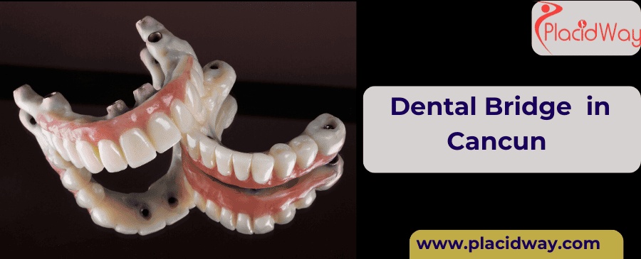 Dental Bridge  in Cancun 