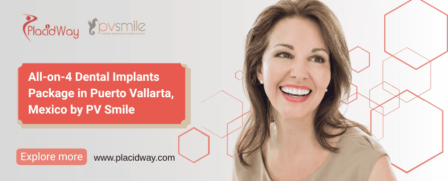 Implantes Dentales Puerto Vallarta Oferta All-on-4 PV Smile
