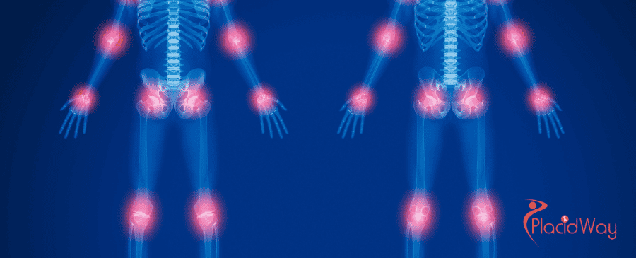 Terapia con células madre en México