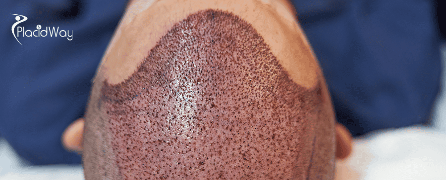 Hair Transplant in Turkey