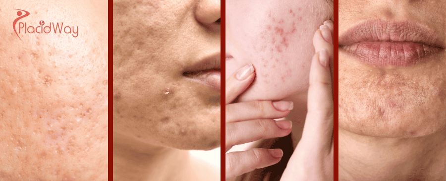 Acne Scar Treatment in South Korea