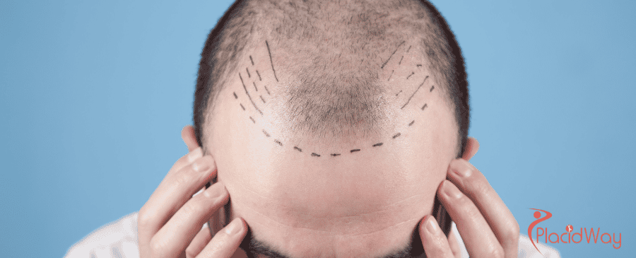 FUE Hair Transplant in Turkey