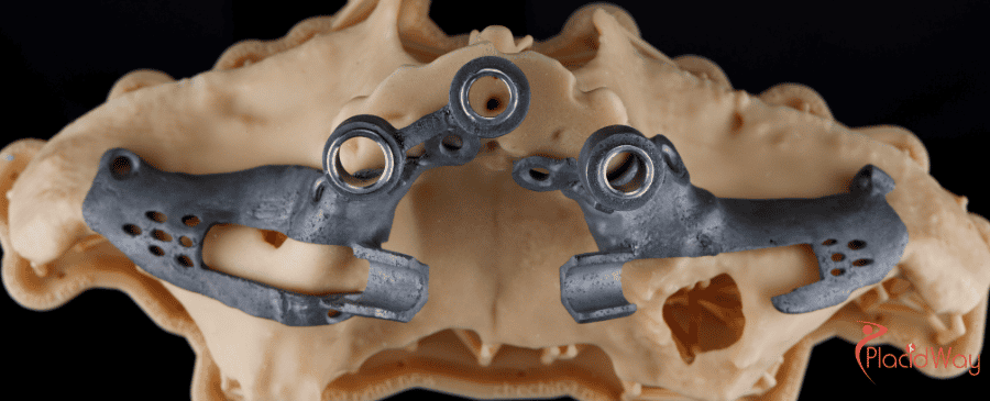 Zygomatic Implants in Vietnam