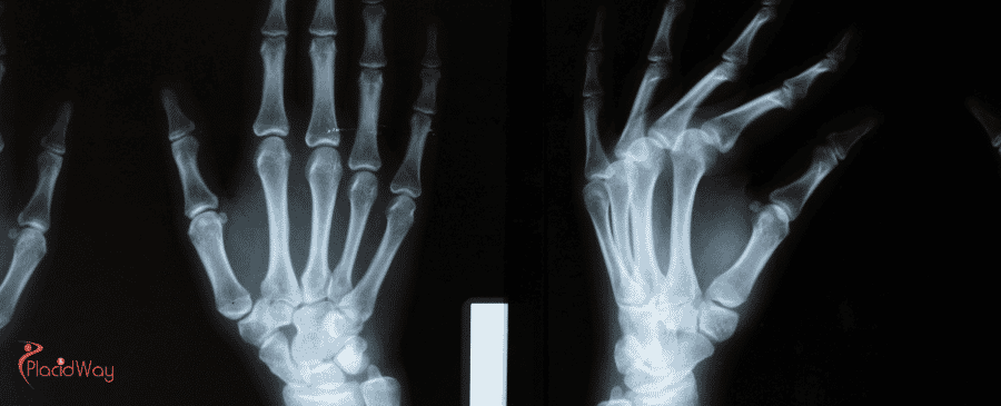 Carpal Tunnel Surgery in Turkey