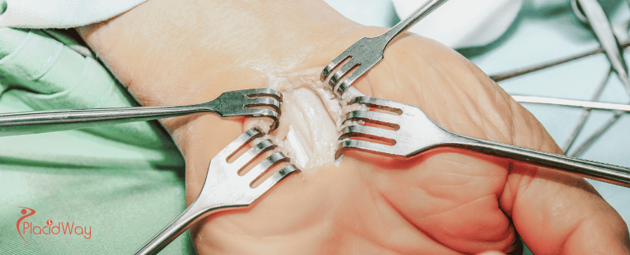 Carpal Tunnel Surgery in Turkey