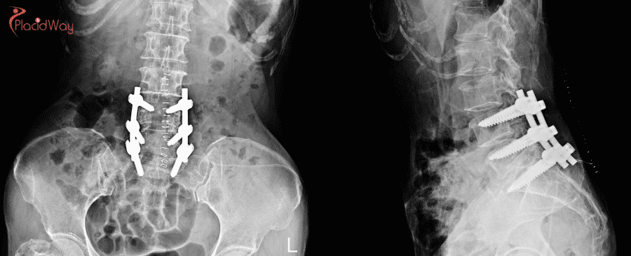 Laminectomy in Turkey