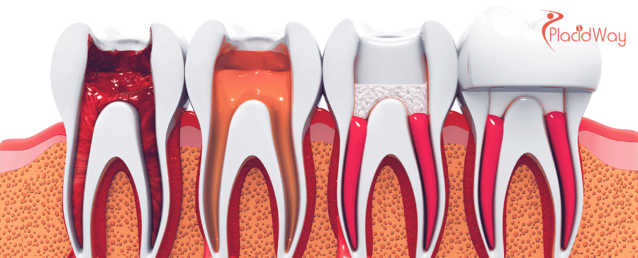 Root Canals in Mexico for Texans