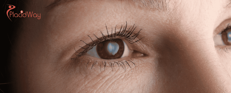 Cataract Surgery in Mexico