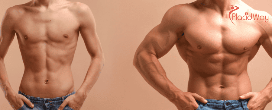 Breast Reduction in Turkey, gynecomastia surgery in Turkey