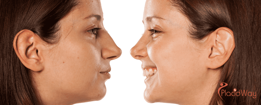 Rhinoplasty in South Korea