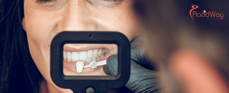 Veneers in Turkey, Porcelain Veneers in Turkey