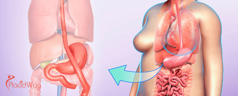 Magenbypass in der Türkei