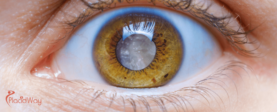 Cataract Surgery in Turkey