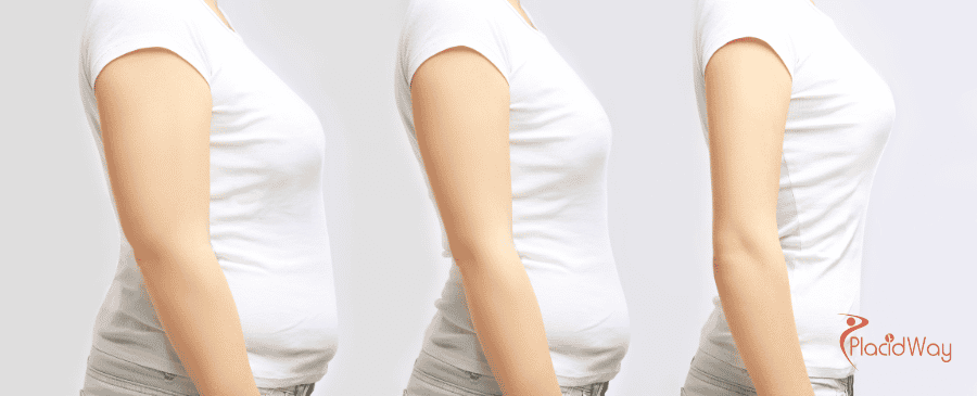 Gastric Sleeve Surgery in Mexico