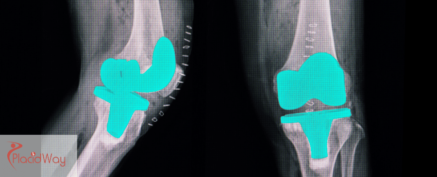 knee replacement surgery in Mexico