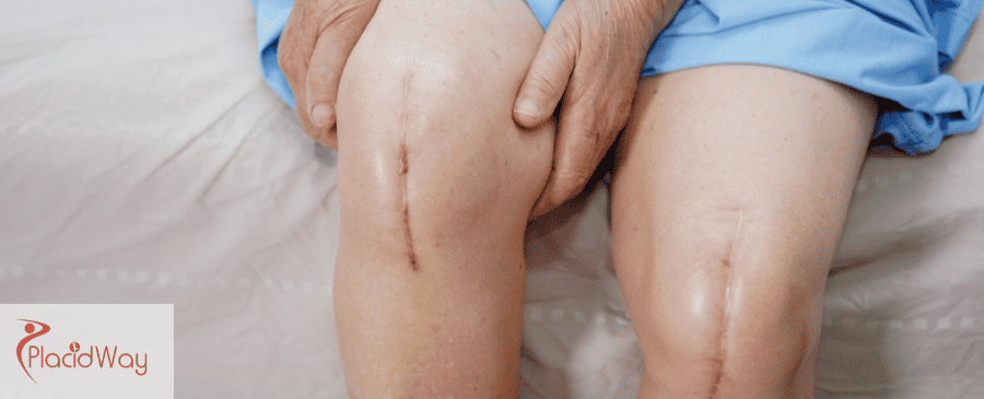 knee replacement surgery in Mexico