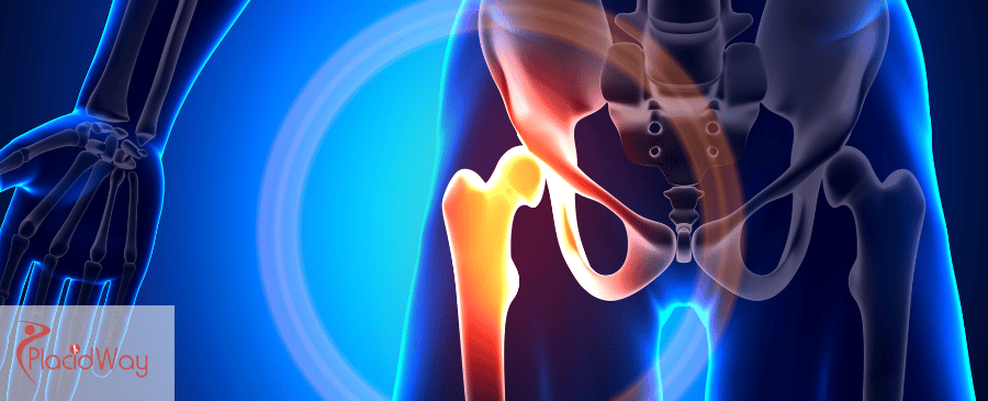 Joint Arthroscopy in Mexico