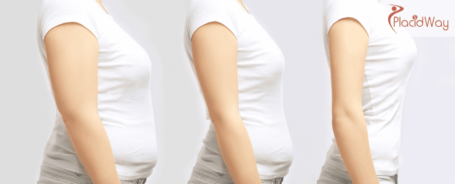 Magenballon in der Türkei