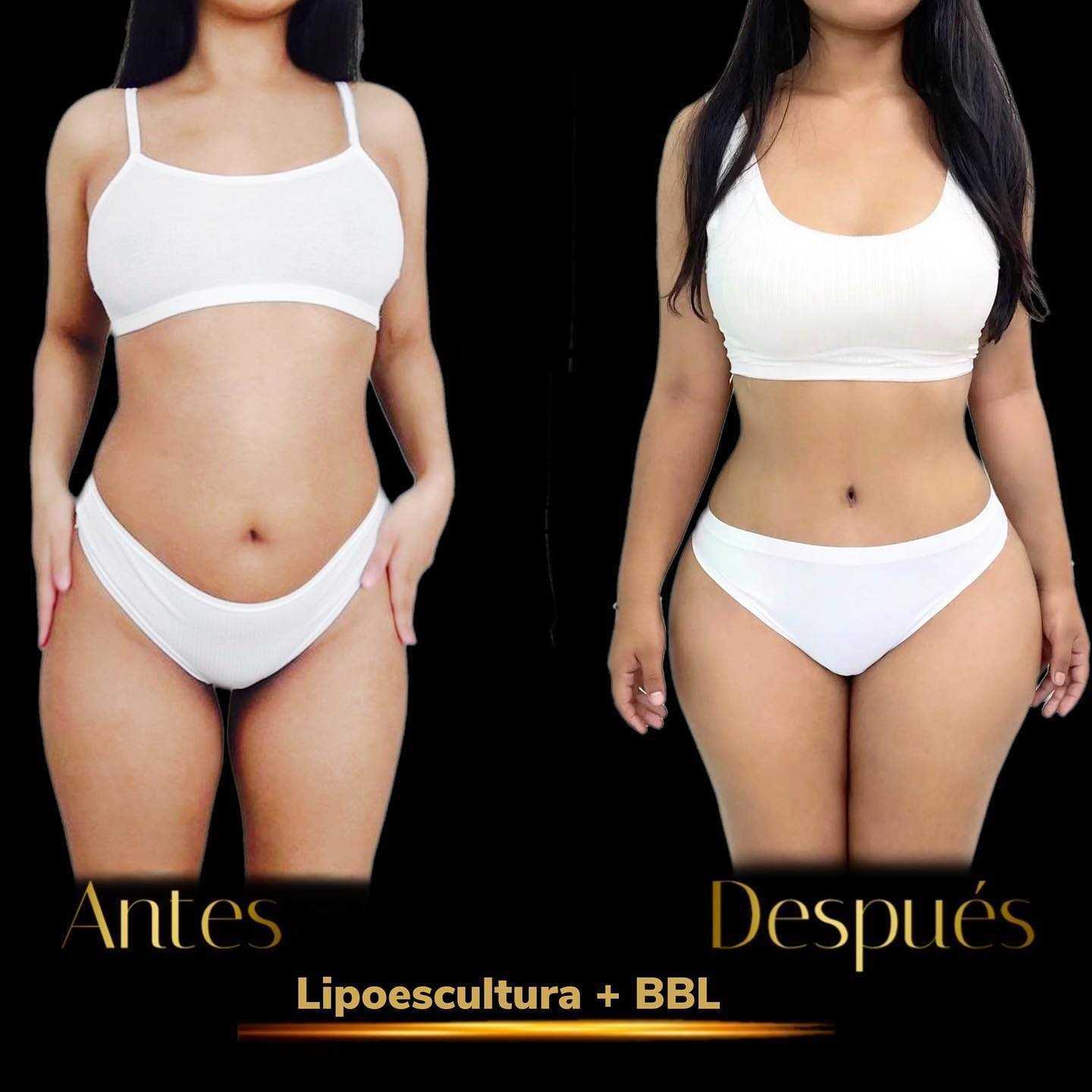 Antes y después de una liposucción con aumento de glúteos brasileño en Tijuana, México