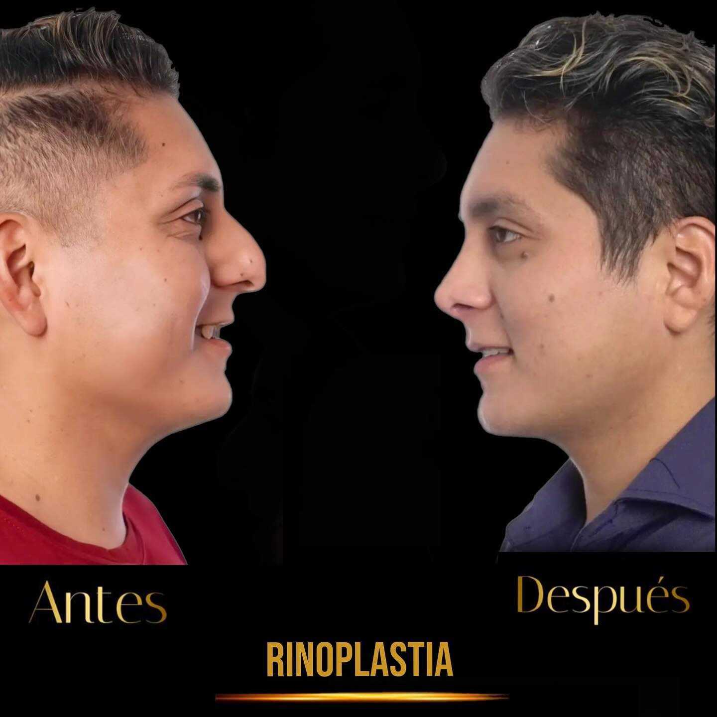 Antes y después de una rinoplastia en Tijuana, México