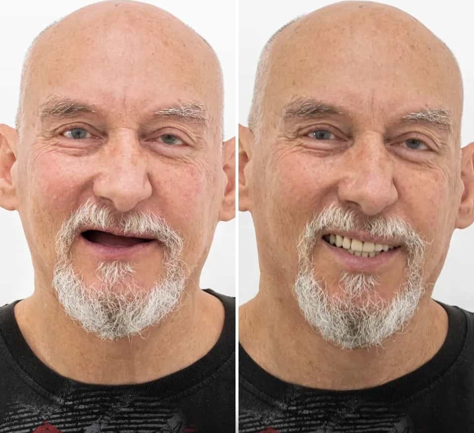 Before and After Snap on Denture in Los Algodones Mexico