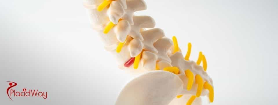 Artificial Disc Replacement in Turkey