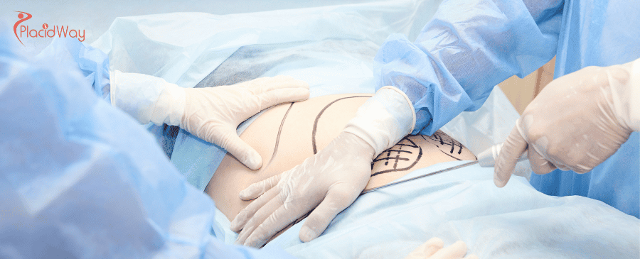 Liposuction in Thailand
