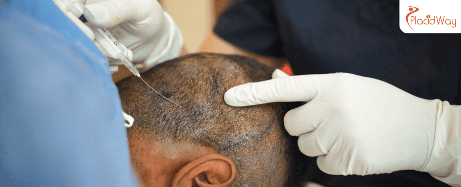 hair transplant in Turkey