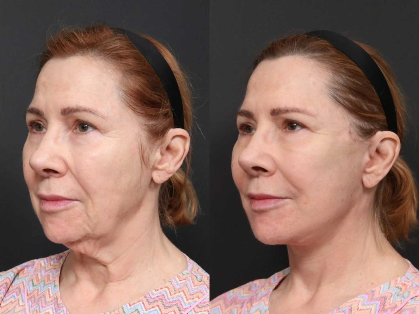 Before and After Deep Plane Facelift in Seoul South Korea