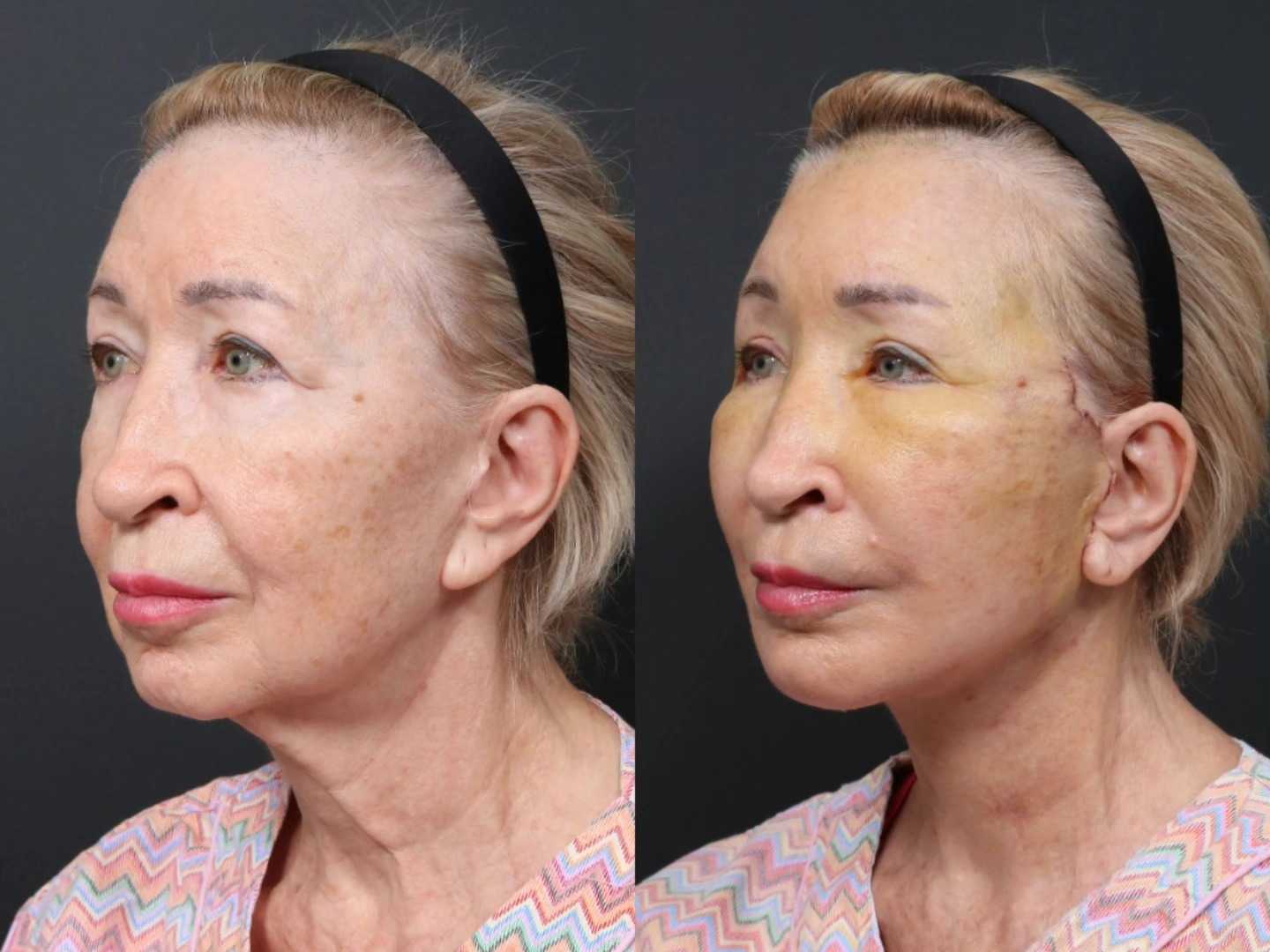 Before and After Neck Lift in Seoul South Korea