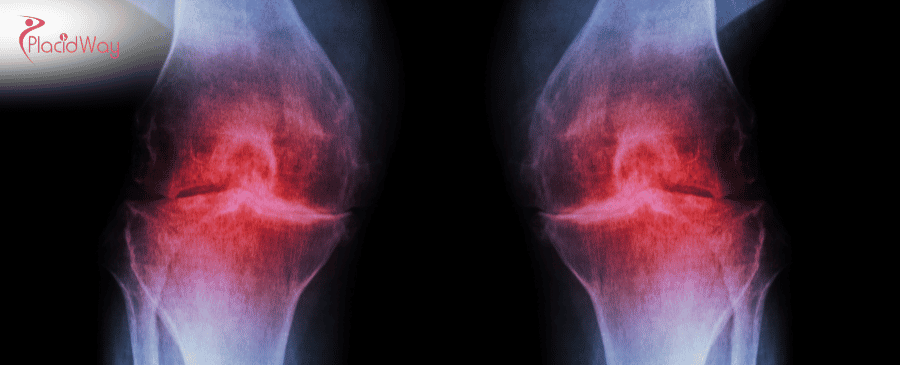 Stem Cell Therapy for Osteoarthritis in Turkey